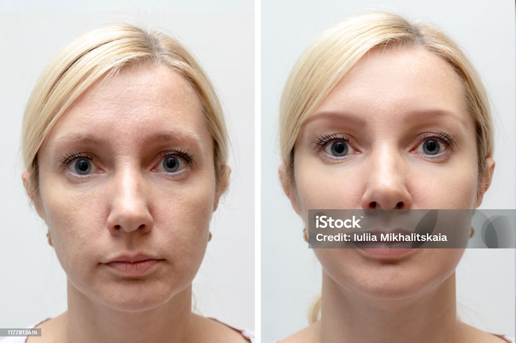 تصویر خانم قبل و بعد لیفت صورت و گردن