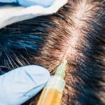 کاشت مو برای خانم ها در کلینیک فوق تخصصی کاشت مو