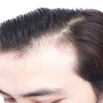 درمان شکاف های مو در جلوی سر